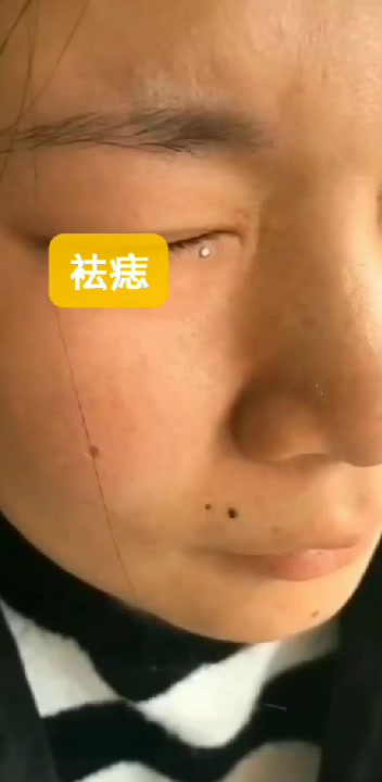 黑痣  蓝痣  肉痣  专业祛除