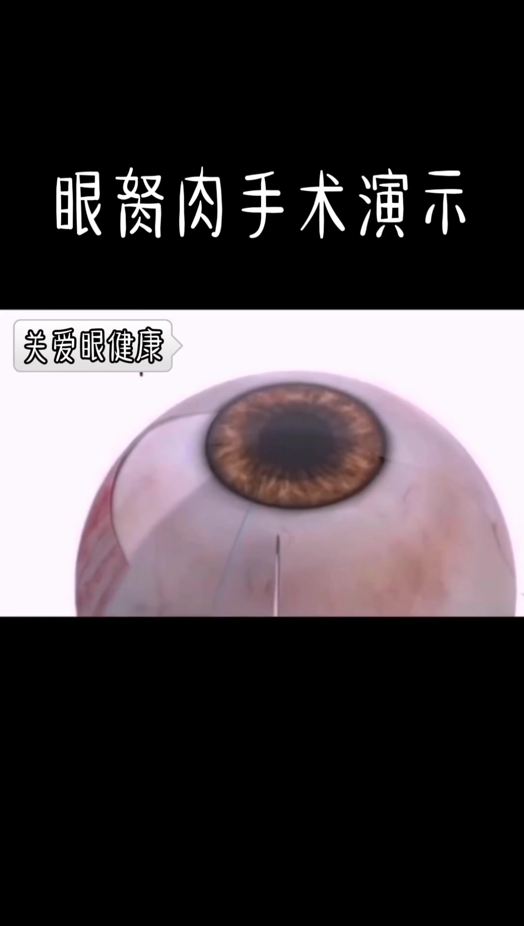 眼胬肉手术切除演示