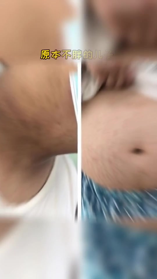 17岁男孩228斤,出现黑棘皮、紫纹……医生对爸妈直摇头