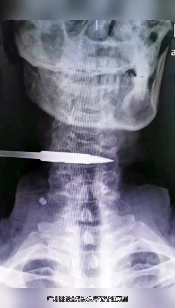 忐忑!男子用弹弓打鱼,没想到将鱼鳔射进了自己的脖子……