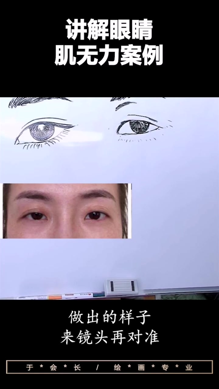 于文红会长绘画讲解眼睛肌无力案例之小玉酱篇(一)