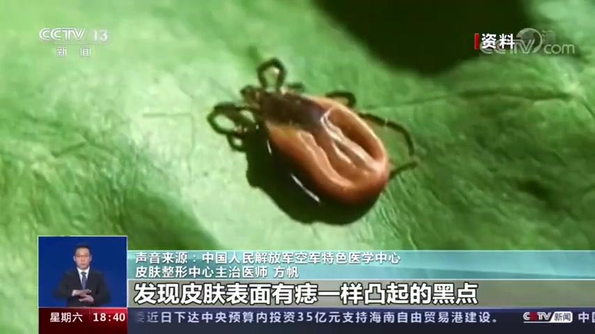 【[话筒]扩散!蜱虫叮咬高发 野外游玩务必当心!】近日,江苏常州的小琳踏青后腿长红斑,伴发