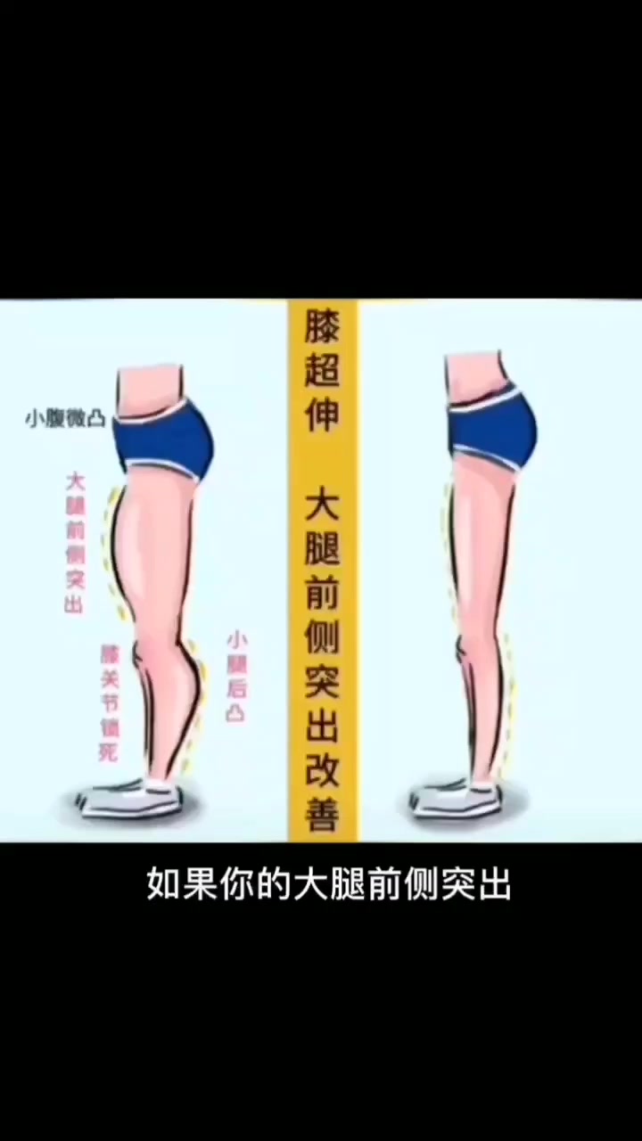 大腿前侧突出小腿后侧突出 膝盖痛 膝超伸 改善 纠正腿型  !