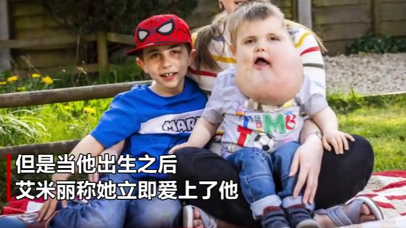 【英国一四岁男孩脸上长囊肿 有葡萄柚大小把脸撑变形】英国萨默塞特郡四岁的男孩亚历克斯脸上长