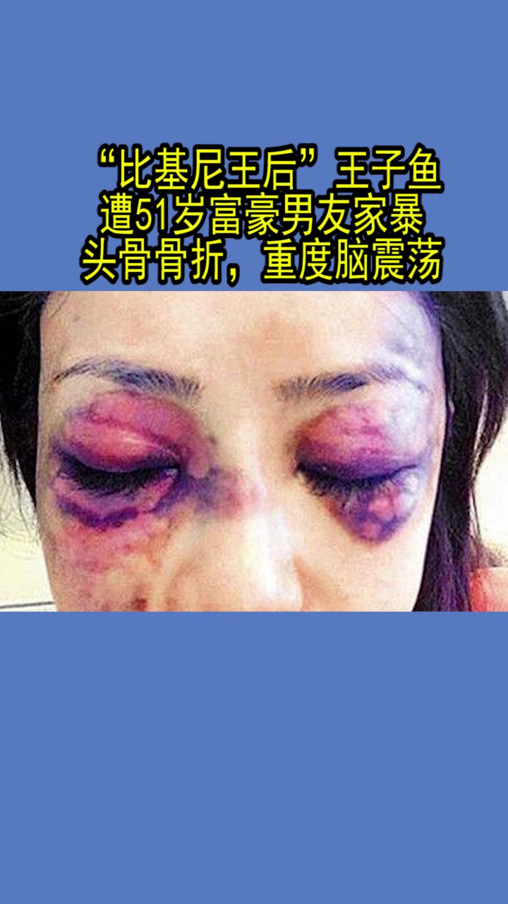 “比基尼王后”王子鱼:遭51岁男友家暴,头骨骨折、重度脑震荡