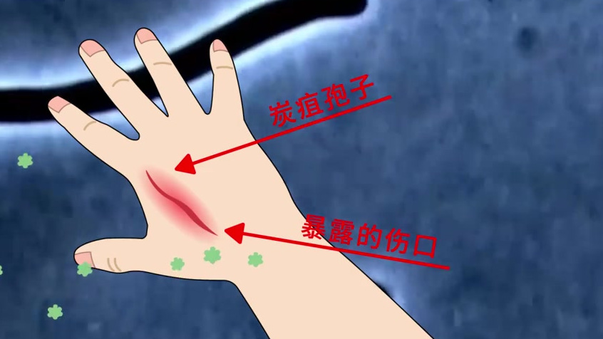 【[话筒]感染炭疽病毒什么症状 ?该怎样预防?[话筒]】肺炭疽到底有多可怕?据了解,炭疽病