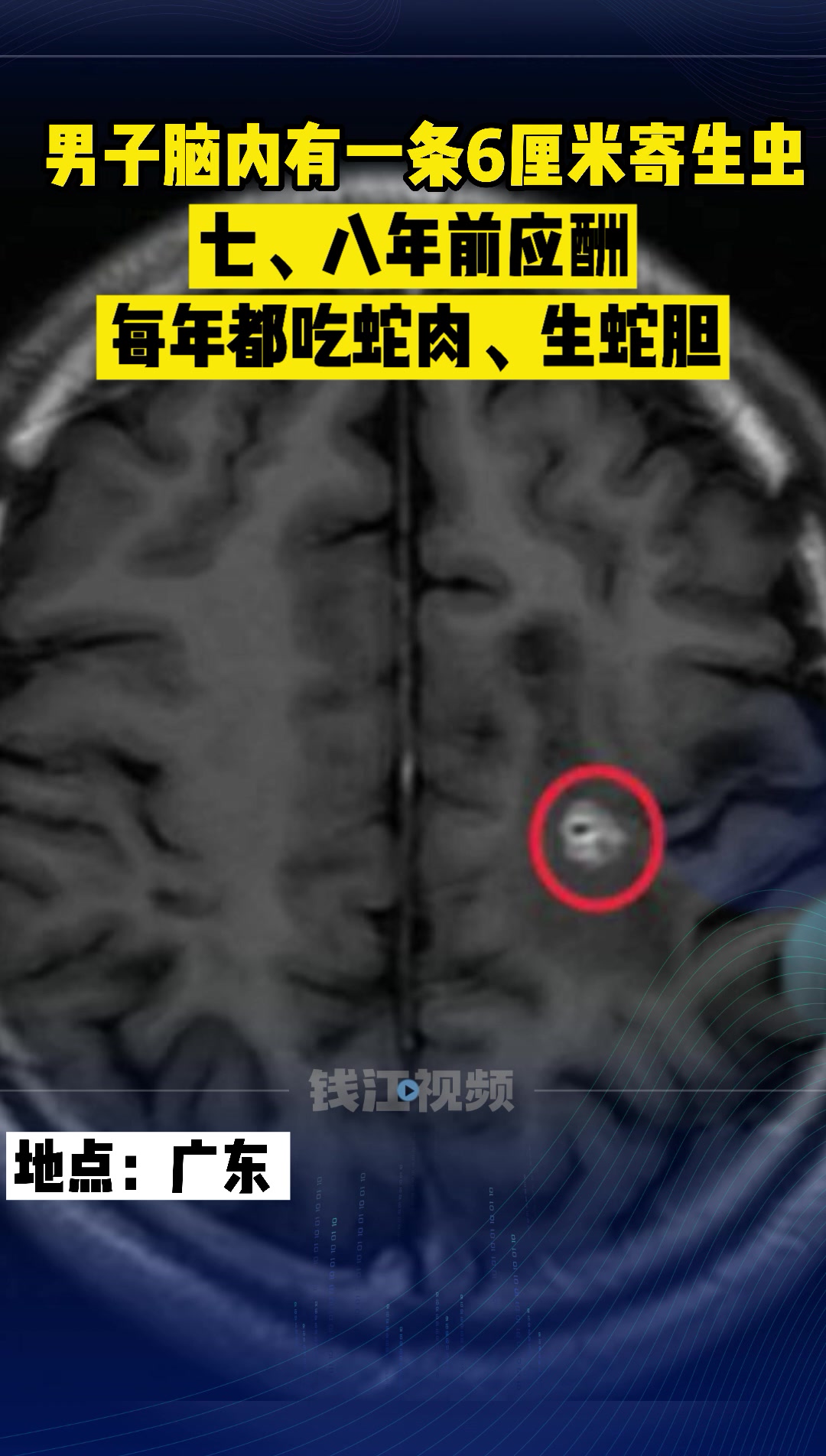 广东一男子脑内有一条6厘米寄生虫,疑与曾吃蛇肉、吞生蛇胆有关
