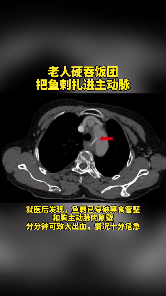 老人硬吞饭团把鱼刺扎进主动脉!医生:鱼刺卡喉后“土法”不可取