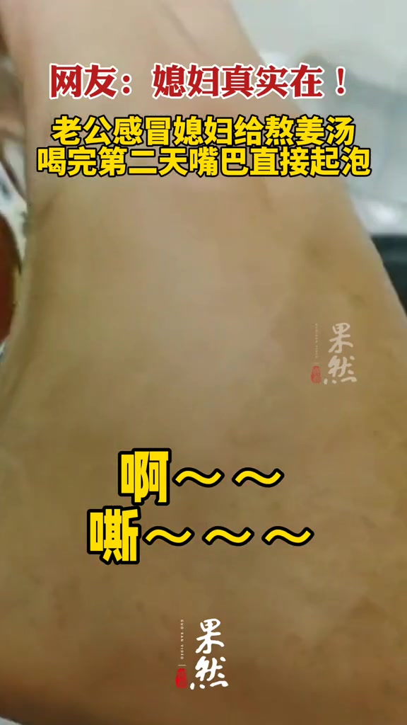 老公感冒媳妇给熬姜汤,喝完第二天嘴巴直接起泡。网友:这媳妇真实在!