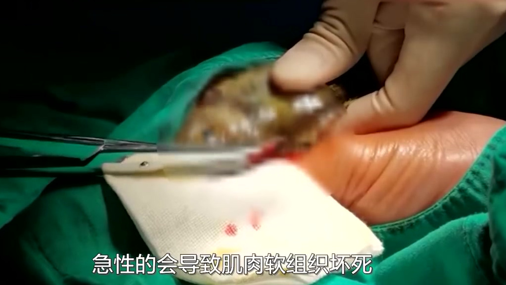 【女子被鱼刺扎手举鱼求医 医生:不硬拔是对的】近日,广西陈女士在家杀鱼时,不慎将一条泥猛鱼