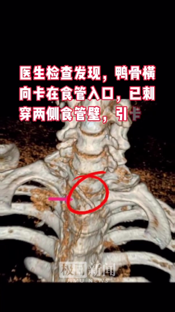 「视频」爹爹不慎吞下鸭骨后用“土办法”处理,谁知食管被刺了个对穿