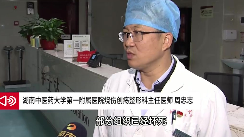 【注意!女子被鸭子抓伤致坏死性筋膜炎】近日,湖南长沙,一位五旬女子在家里喂鸭子时被抓伤,随