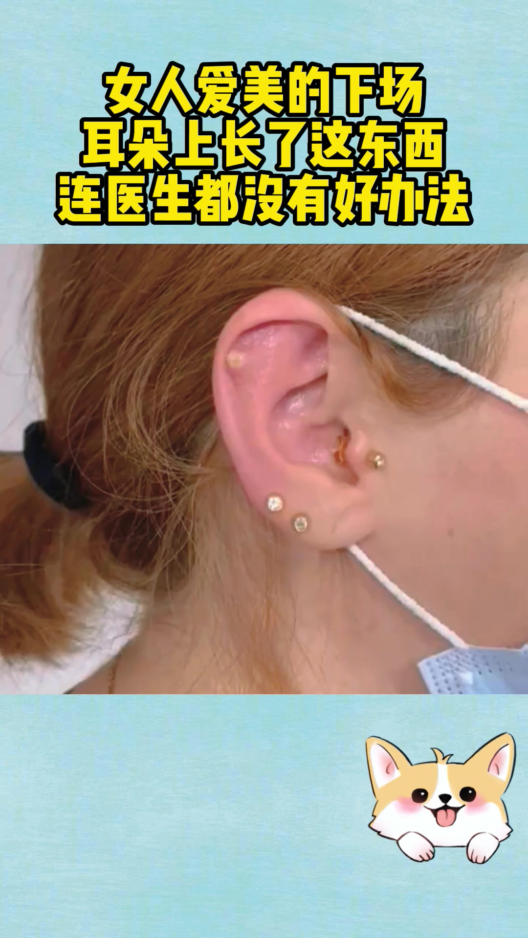 女人爱美的下场,耳朵上长了这东西,连医生都没有好办法
