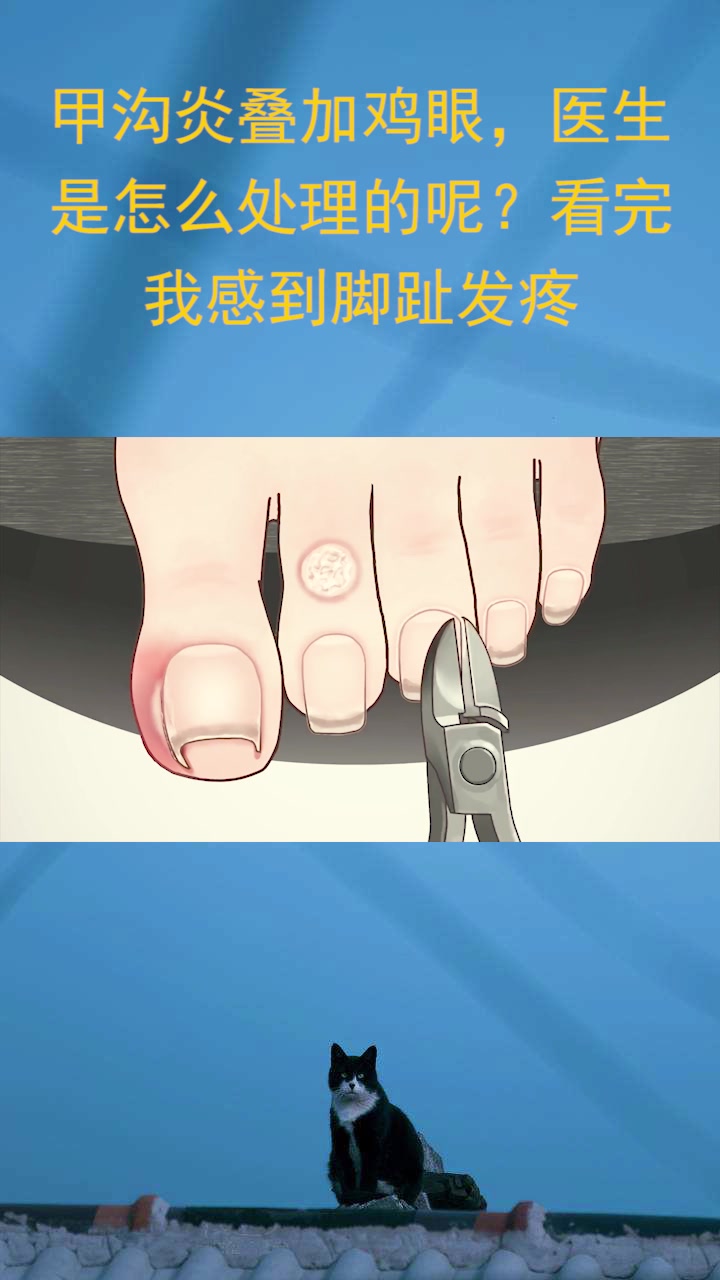 甲沟炎叠加鸡眼,医生是怎么处理的呢?看完我感到脚趾发疼