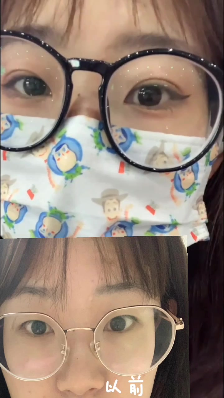 埋线双眼皮49天恢复分享,眼睛基础合适做埋线就很不错!
