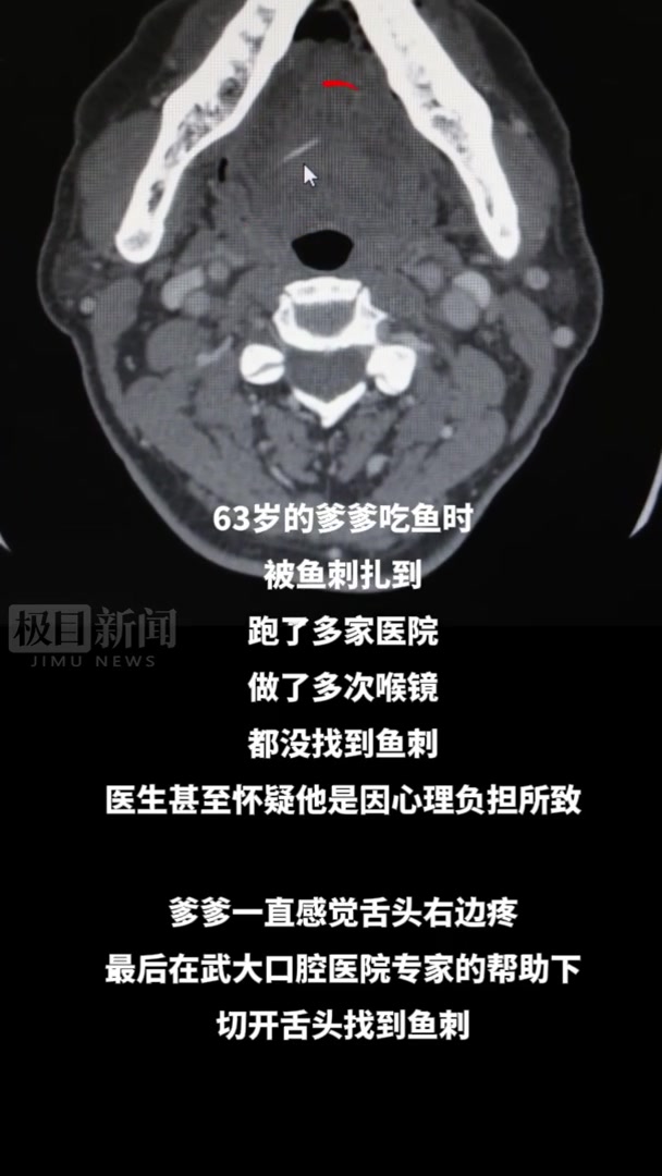 老渔民卡刺后多次喉镜检查均未找到鱼刺,医生切开舌头找到了“肇事者”