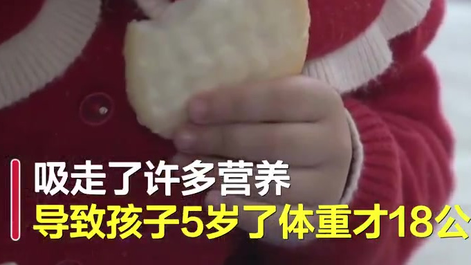 【沈阳5岁女孩头顶长28厘米肿瘤如帽子:吸走了营养 5岁仅18公斤】辽宁沈阳,女孩诗诗(化