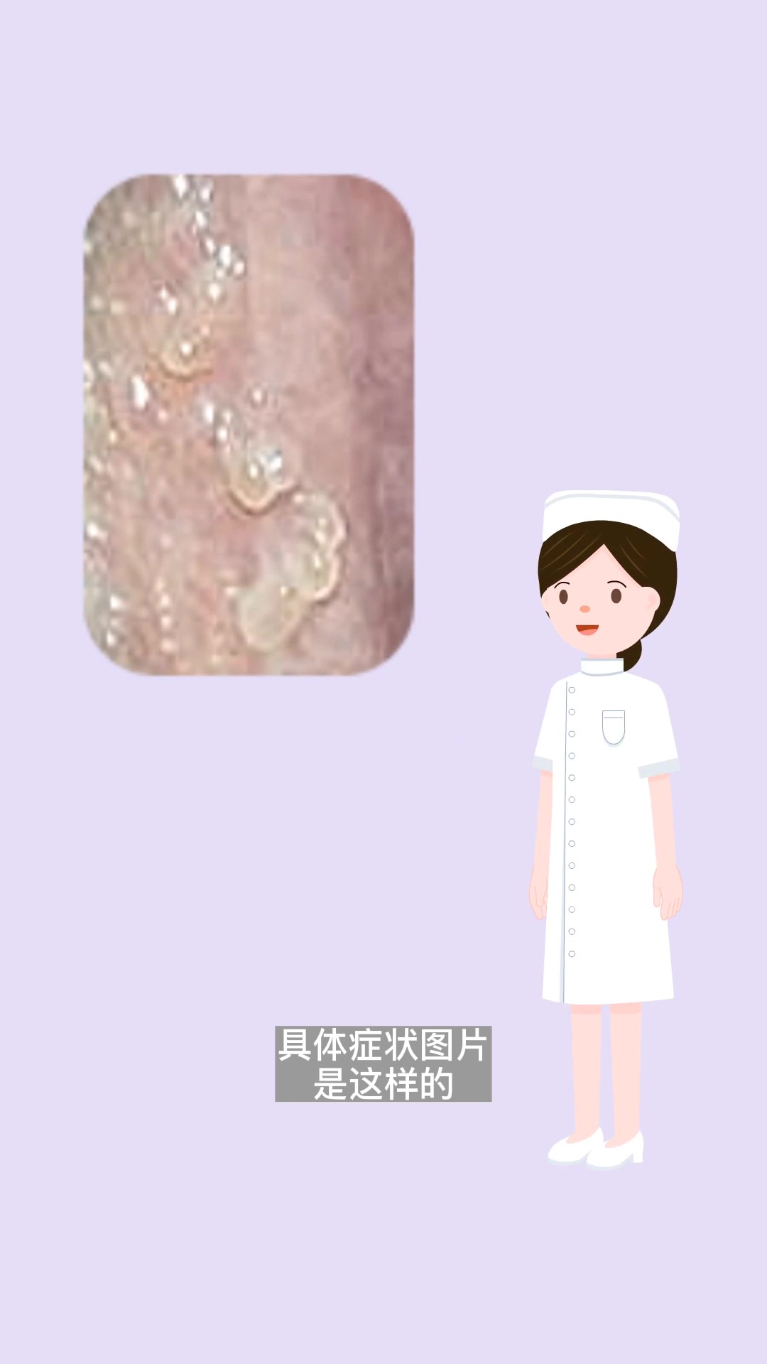 女性假疣和真疣的区别图