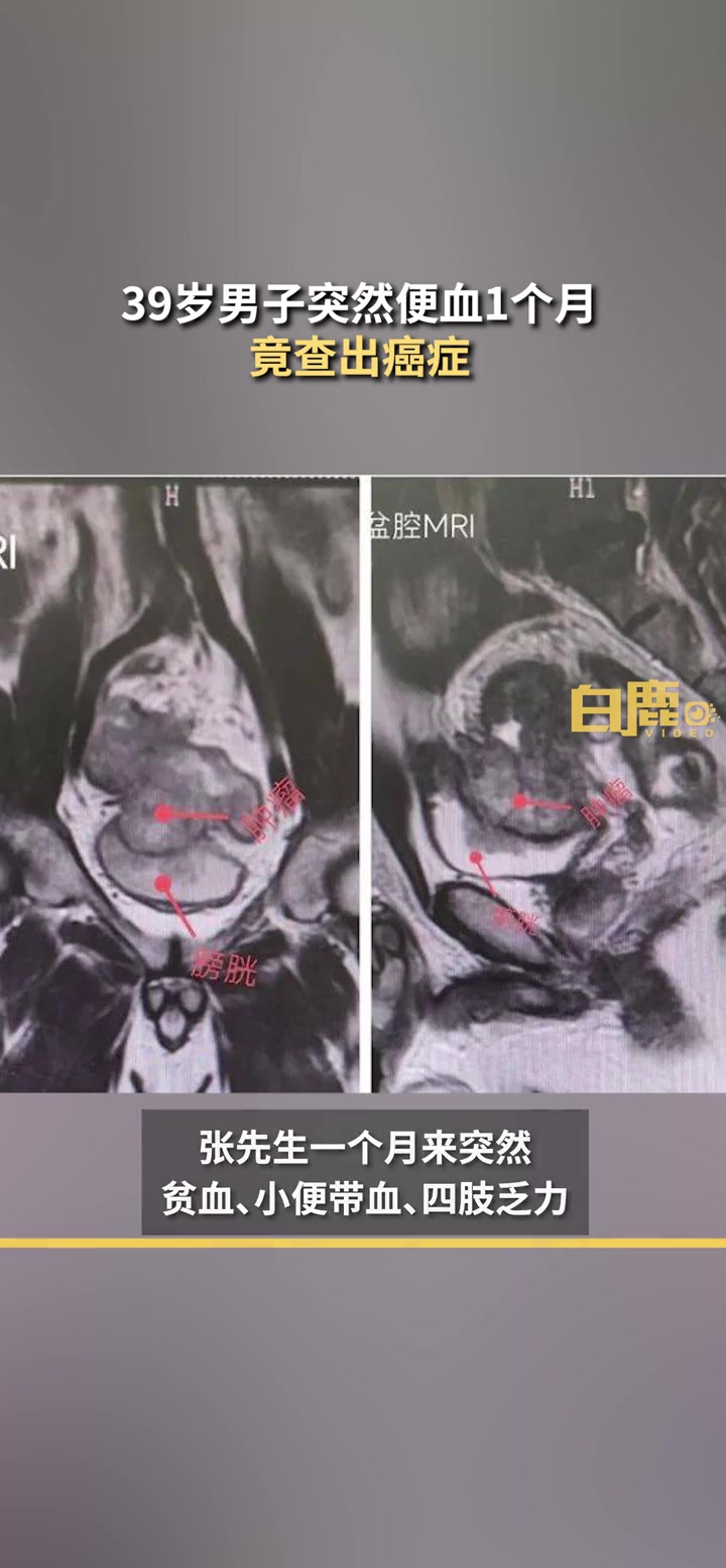 「便血不一定就是痔疮!男子便血1个月一查竟是癌」近日,河南南阳。39岁的张先生(化名)突然