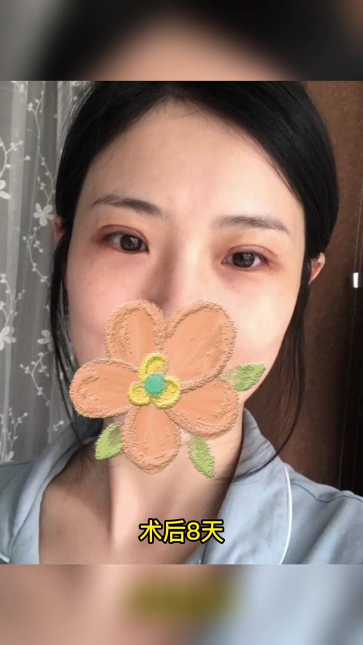 埋线双眼皮修复80天啦!术前上睑脂肪肥厚!术后双眼皮明显又好看