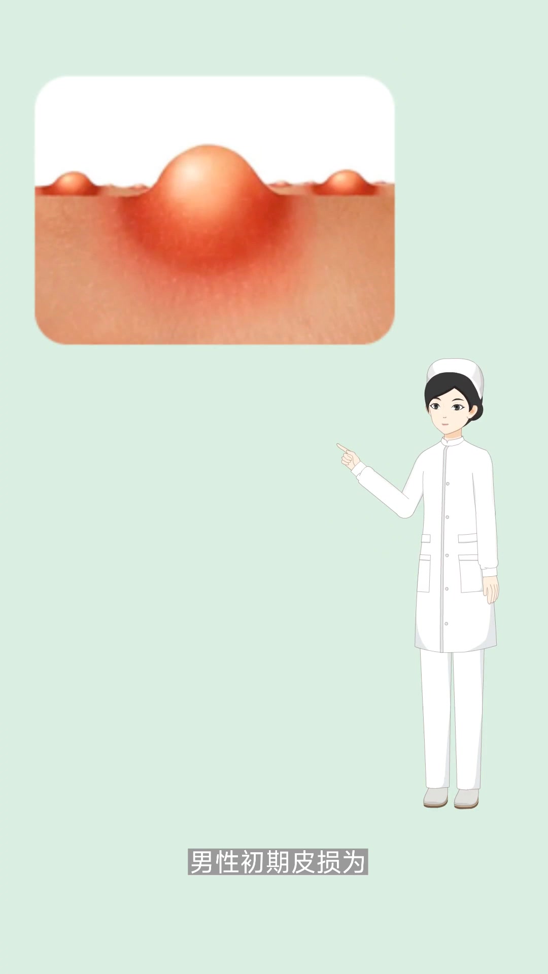 男性长菜花是什么症状