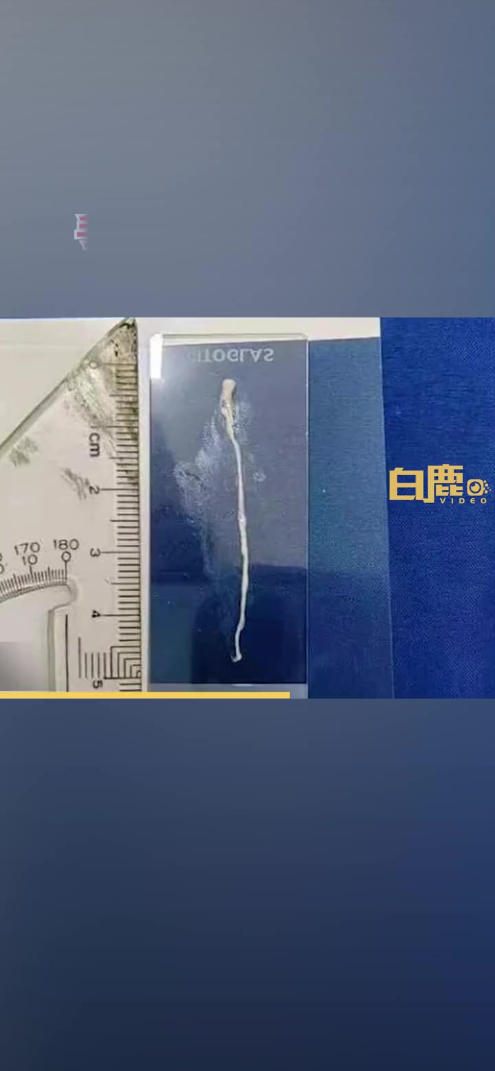 「菜板生熟不分男子忍疼2年肚取活虫:平常还喜欢吃蛇和牛蛙「话筒」」据 白鹿视频 报道:绍兴