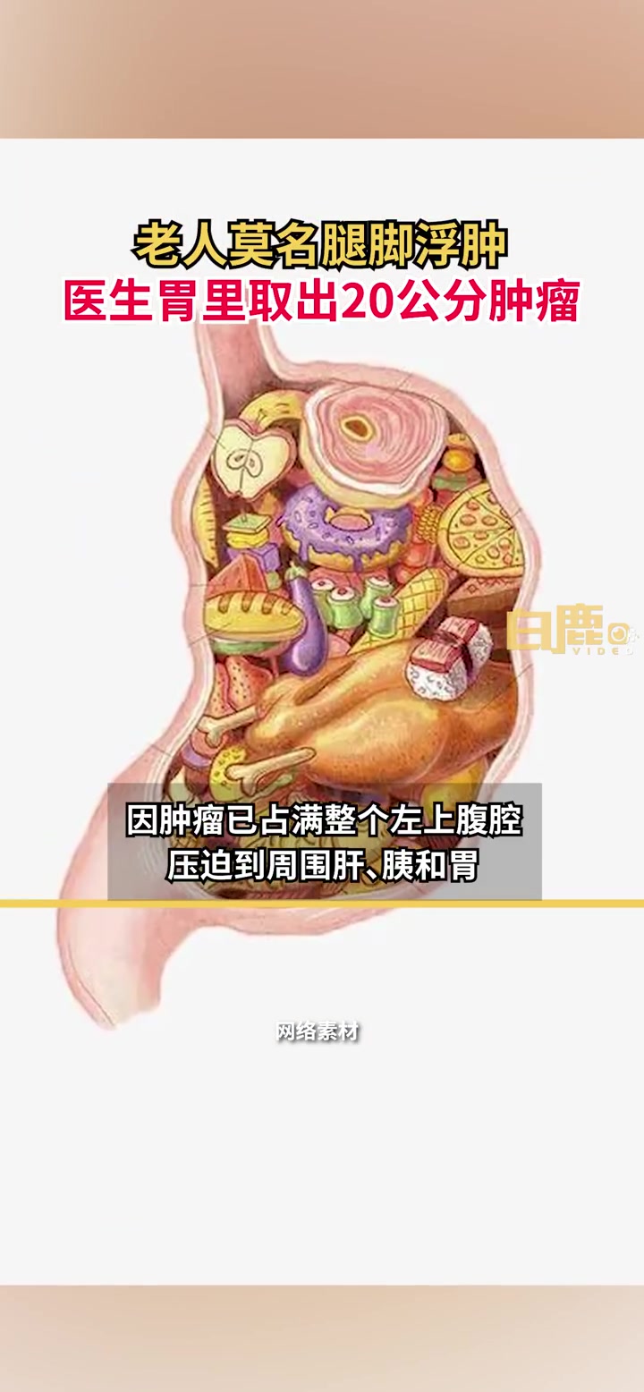 「老人腿脚浮肿8月胃里长柚子大肿瘤」6月13日,浙江宁波。陈奶奶莫名腿脚浮肿已有8个月,起