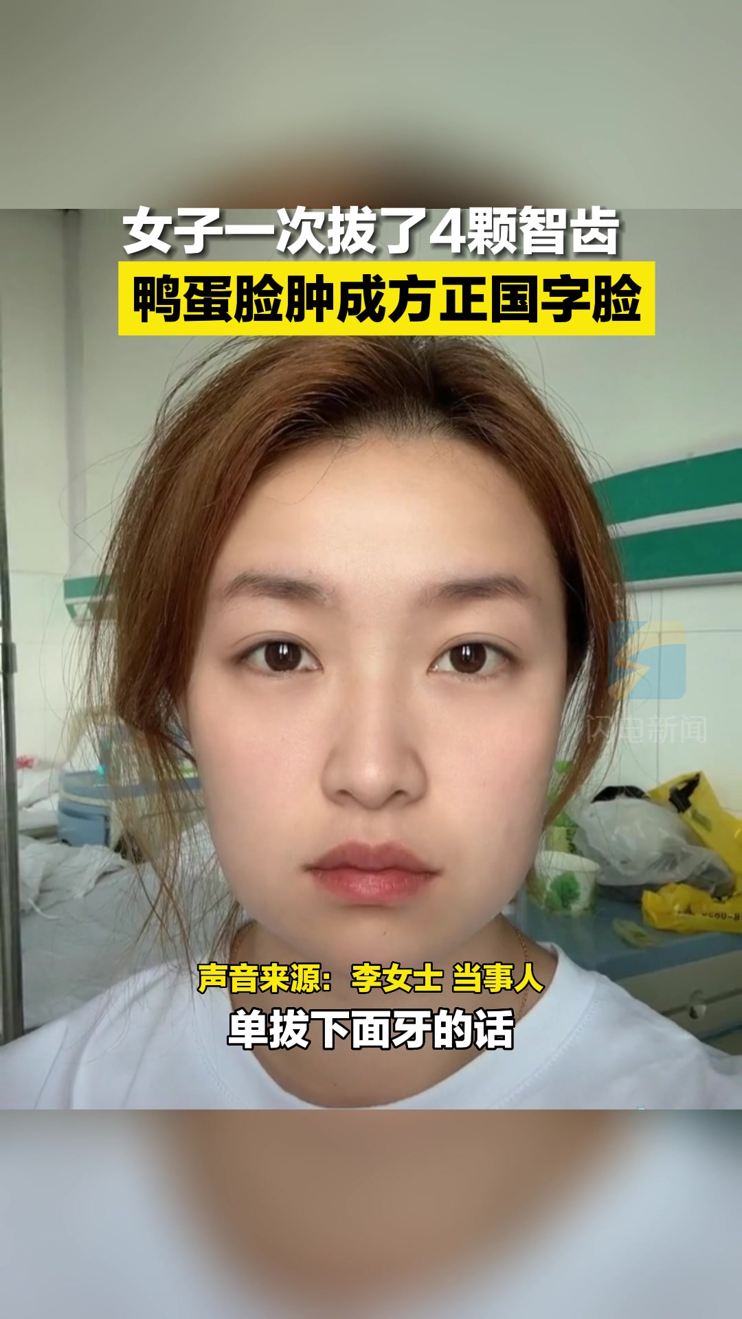 女子一次拔了4颗智齿 鸭蛋脸肿成方正国字脸