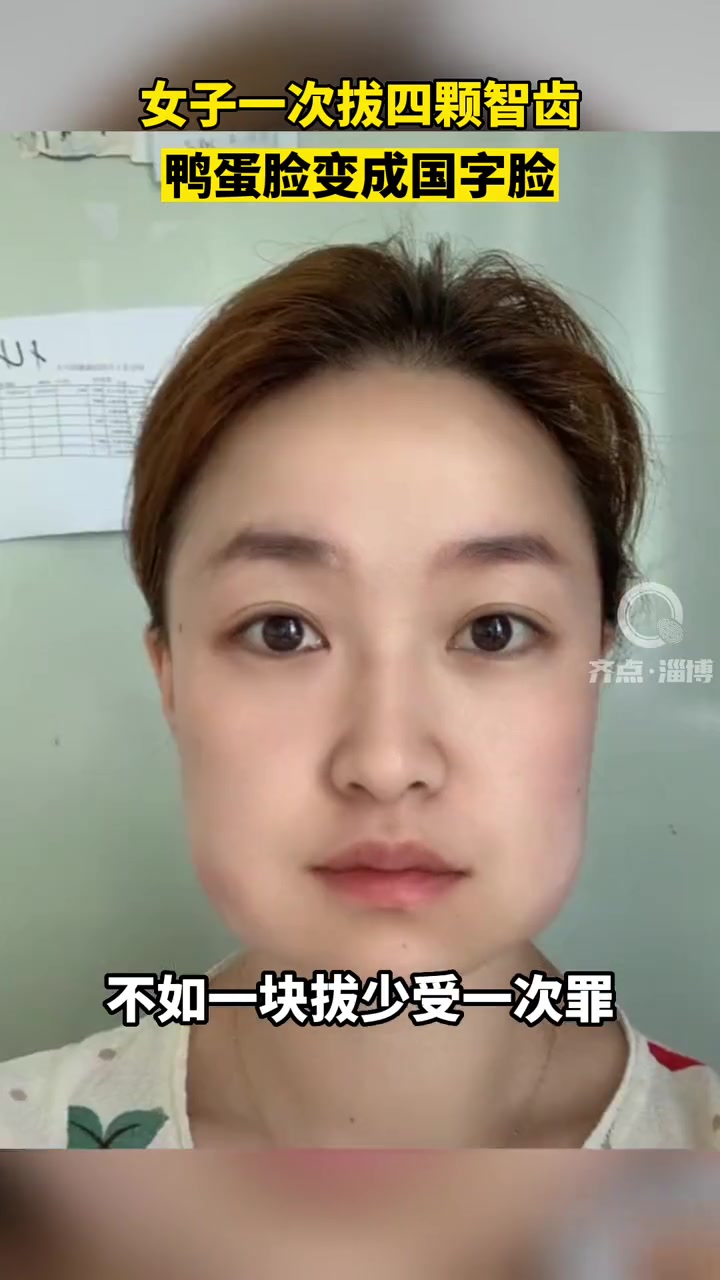 这不是特效!女子一次拔四颗智齿,鸭蛋脸变国字脸!