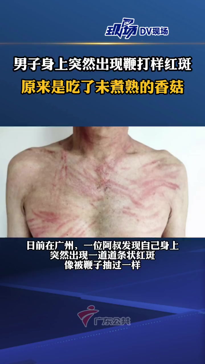 爱吃香菇的要注意了!一位阿叔身体和四肢无缘无故地出现了一道道条状红斑,竟是因为吃了未煮熟的