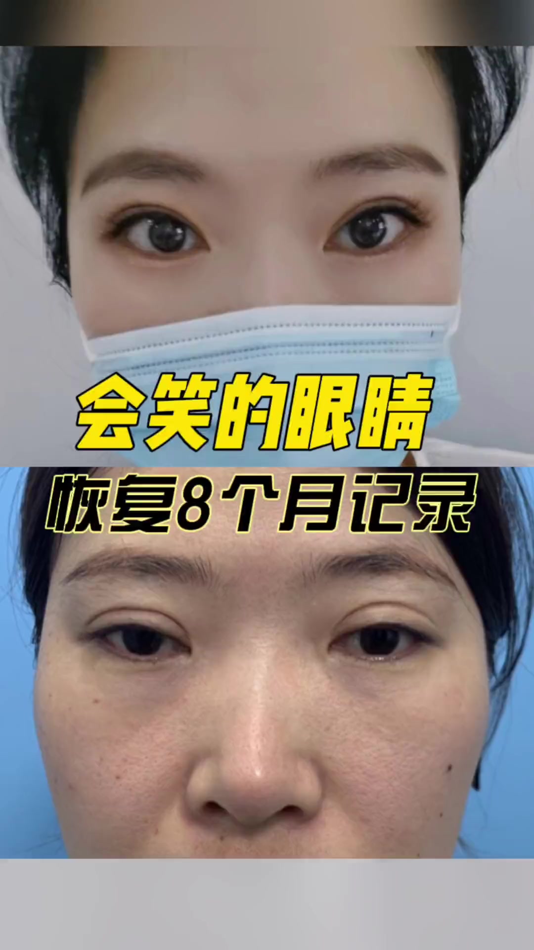 呕心沥血的全切双眼皮修复之路丨一年做两次双眼皮,我真后悔!