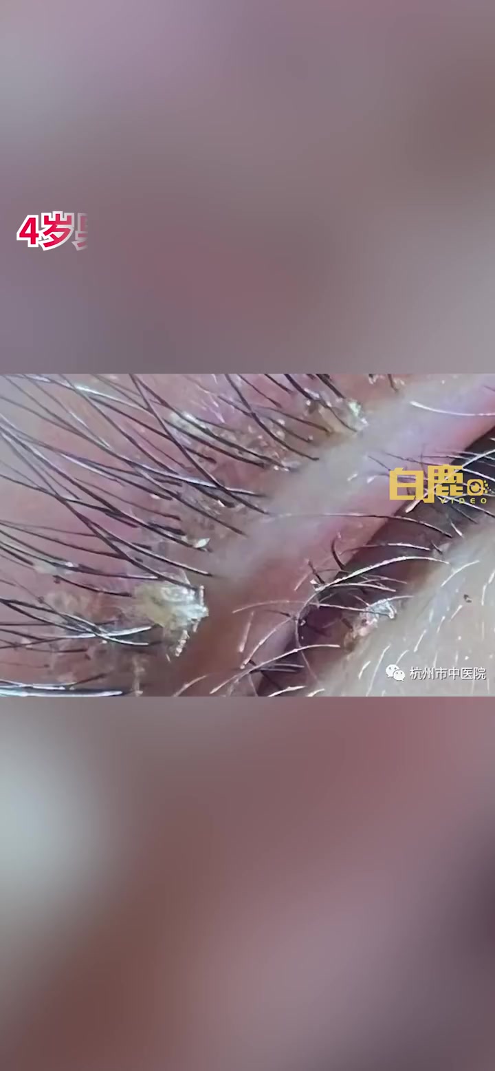 「4岁男童睫毛根部活捉20只阴虱 奶奶身上也现大量阴虱及虫卵」近日,浙江杭州。4岁的男童牛