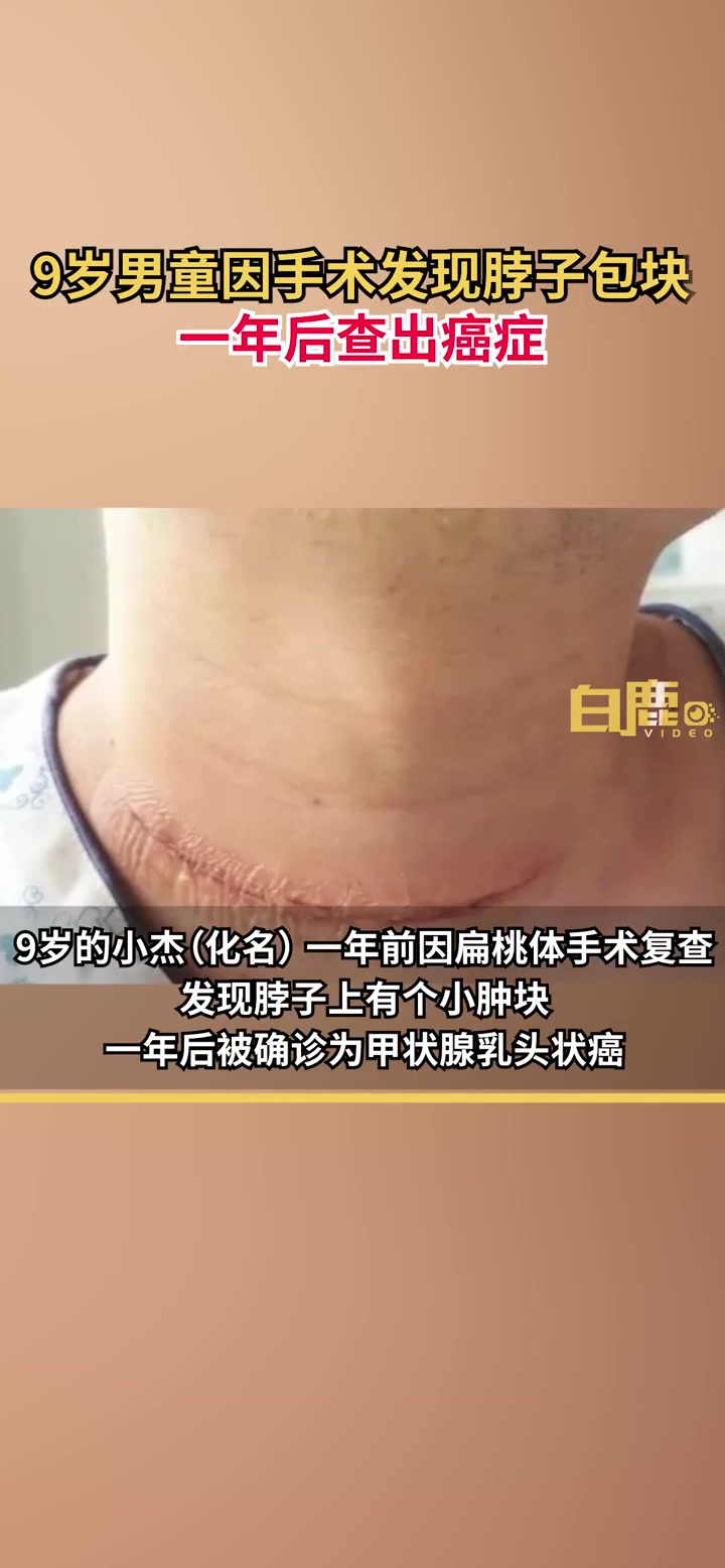 「9岁男孩 因扁桃体手术发现脖长小包块查出癌,目前手术成功已痊愈出院」8月10日,广东深圳