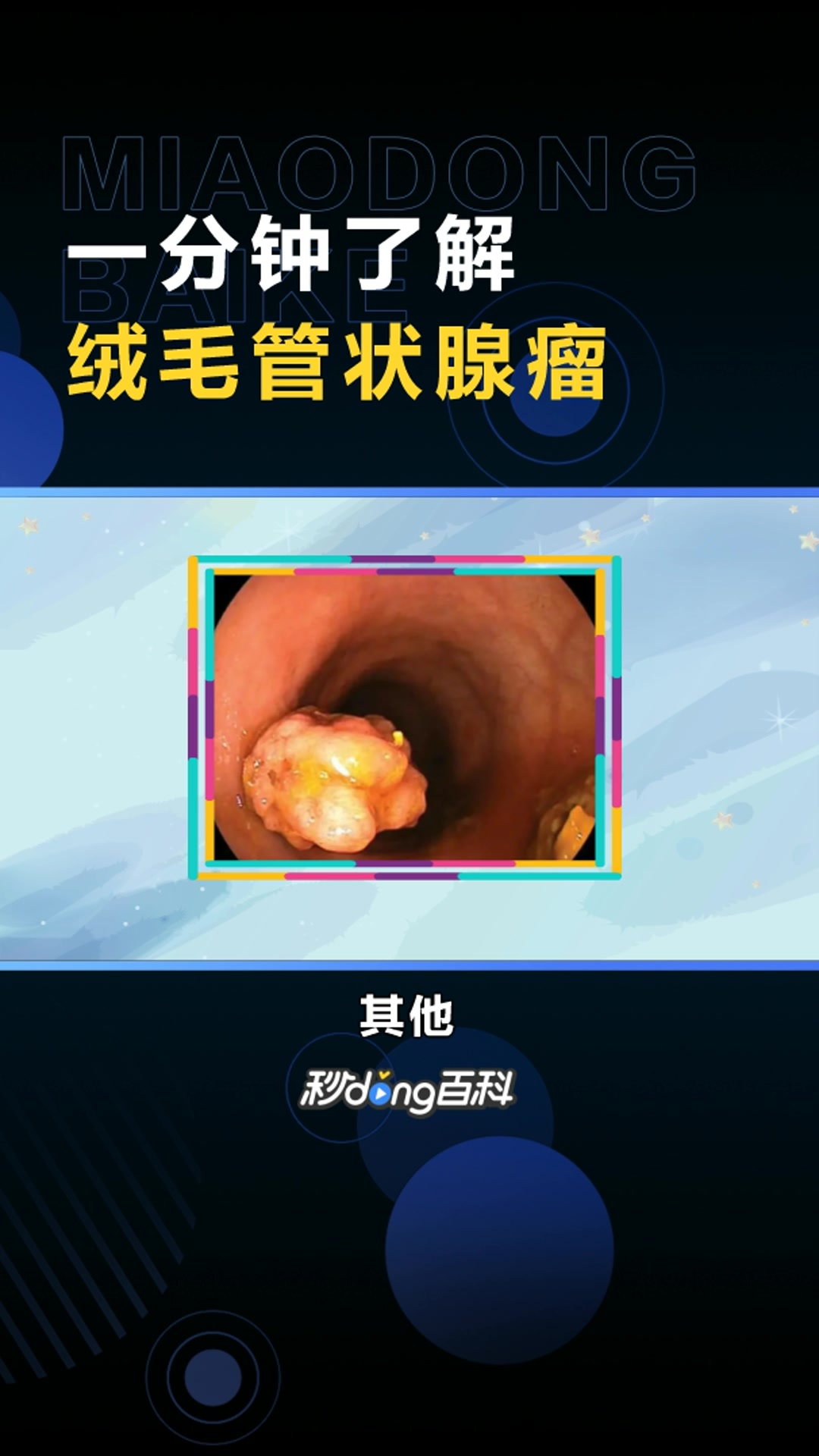 绒毛管状腺瘤:大肠息肉的一种