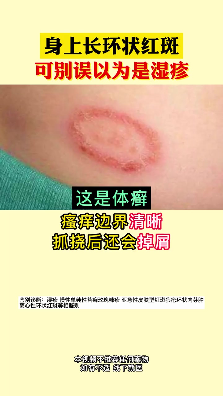 体癣 皮肤 湿疹