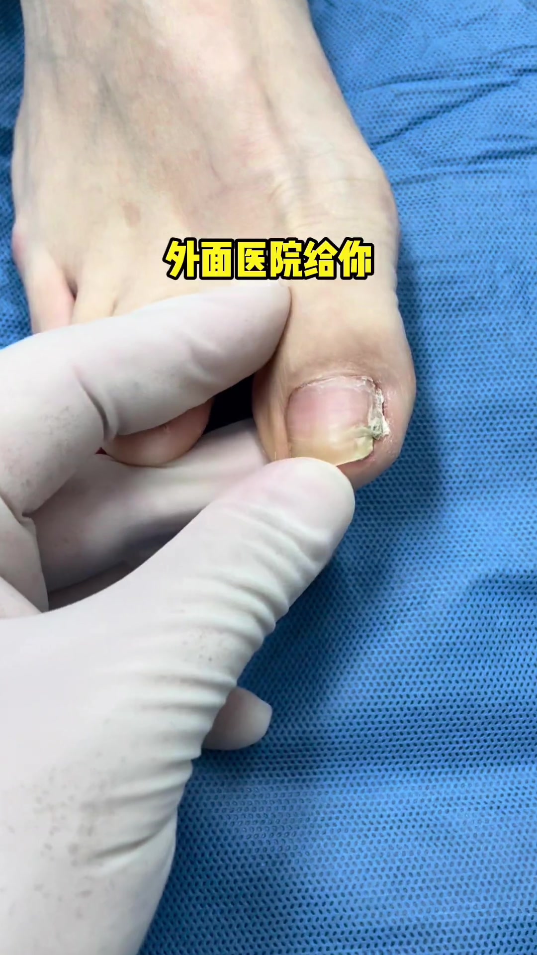 嵌在肉里的指甲剪掉了,新长的指甲还是嵌怎么办?嵌甲 脚趾甲往肉里长怎么办 甲病 息肉 拔甲