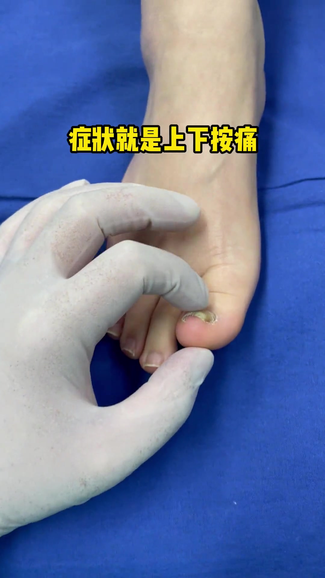 趾骨增生,引发指甲变形,嵌在肉里疼 甲病 脚趾甲往肉里长怎么办 增生