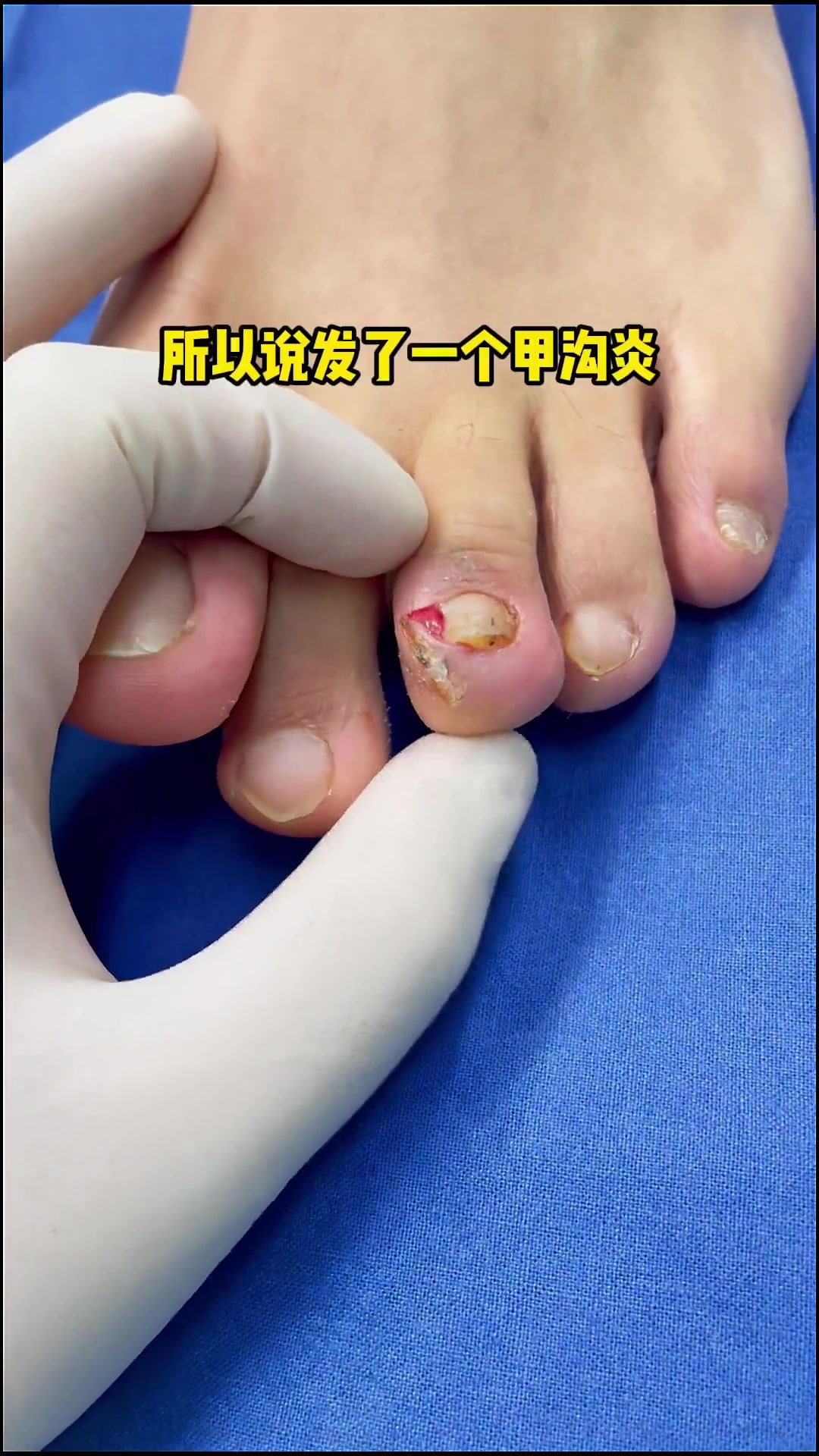 除了大拇指,其他脚趾也会得甲沟炎吗?嵌甲 甲沟 甲病 脚指甲往肉里长怎么办 增生 息肉