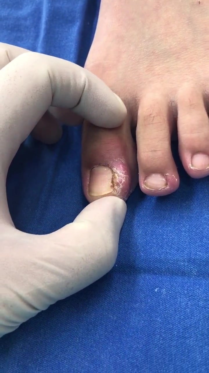 嵌甲甲沟炎肉芽增生,增生的肉芽会自己消退吗?脚指甲往肉里长怎么办 嵌甲 医学科普 脚趾甲 