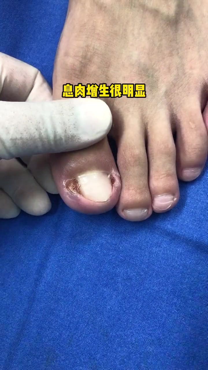 指甲不要剪太短,会容易造成嵌甲甲沟炎 手足护理 脚指甲往肉里长怎么办 医学科普 脚趾甲 甲
