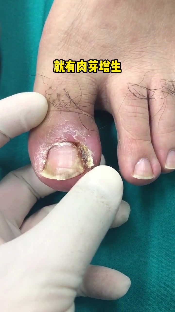 指甲有问题的患者还是不少的,其中嵌甲可以占50% 脚指甲往肉里长怎么办 嵌甲 甲病 脚趾甲