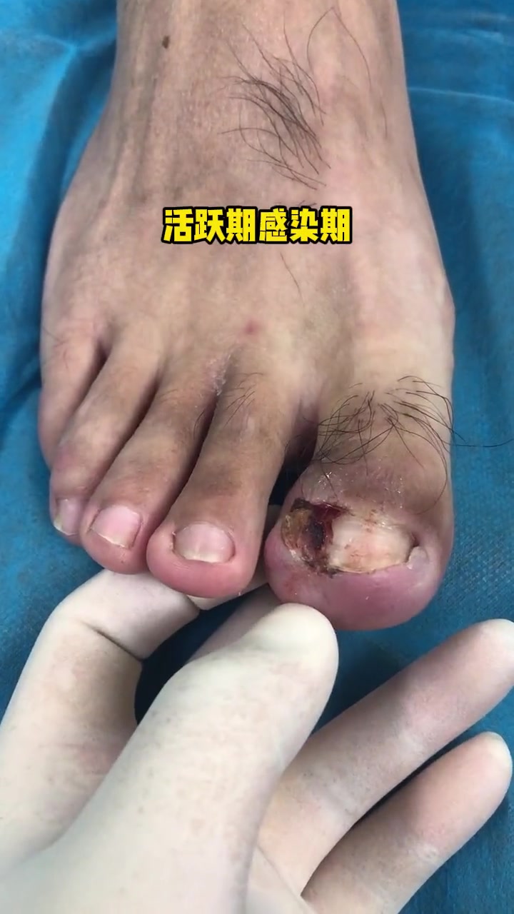 甲型不好,剪指甲失误只需要一次,就会造成嵌甲 脚指甲往肉里长怎么办 医学科普 甲病 嵌甲 