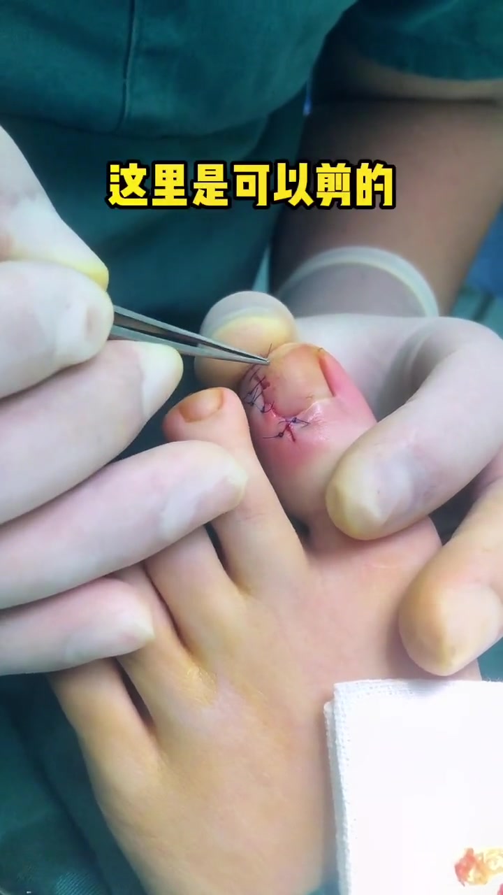 小姑娘嵌甲四个月时间就发展成3度肉芽增生期 脚指甲往肉里长怎么办 脚趾甲 医学科普 甲病 