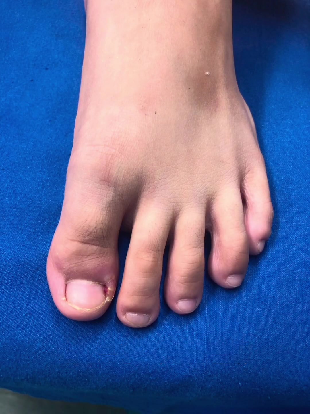 11岁的小朋友,嵌甲;指甲周围已经出现肉芽增生。妈妈发现后及时送到医院检查治疗。关键时刻还