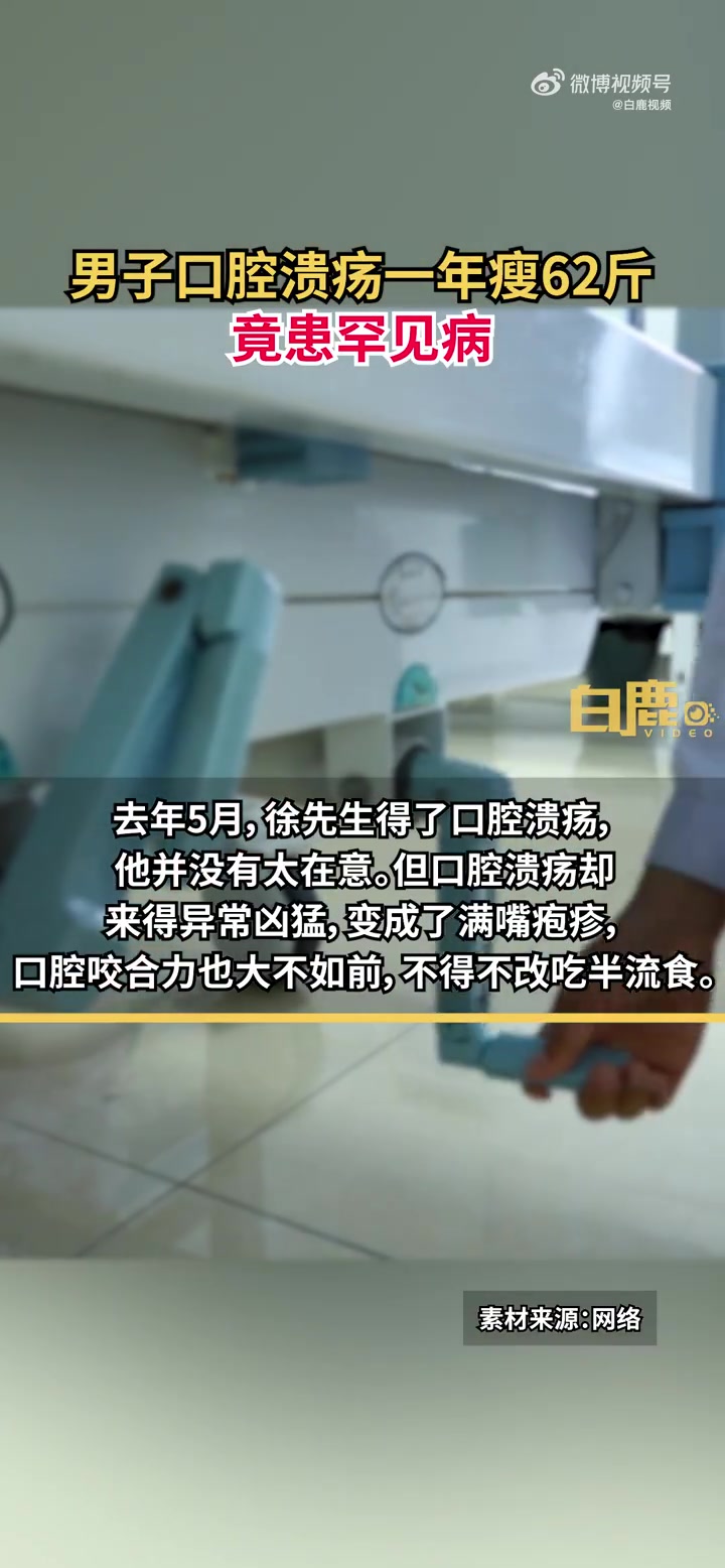 「小病也注意!男子口腔溃疡一年瘦62斤竟患罕见病」近日,浙江杭州。徐先生被反复发作的口腔溃