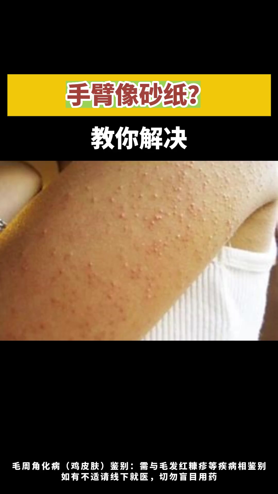 手臂摸上去毛毛糙糙,怎么办?鸡皮肤 医学科普