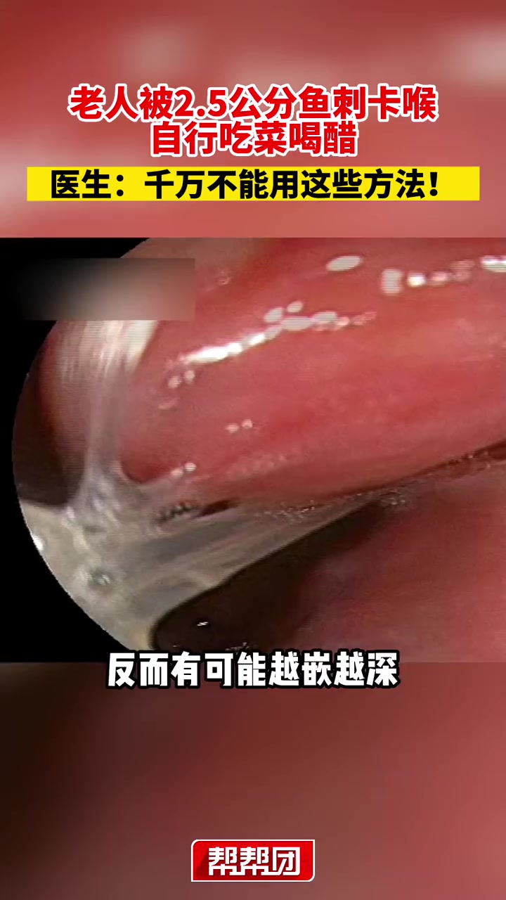 老人被2.5公分鱼刺卡喉,自行吃菜喝醋,医生:千万不能用这些方法!