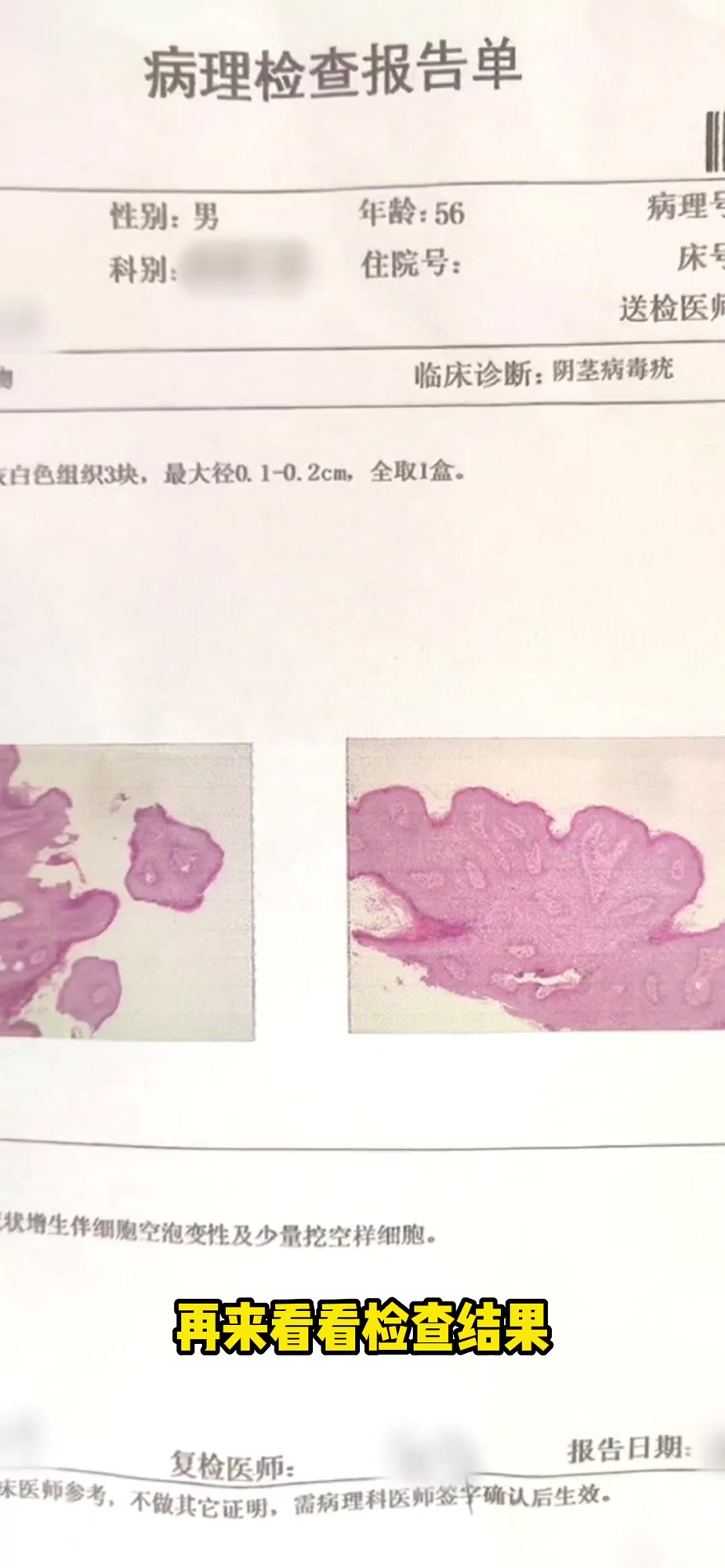 男性长菜花状疙瘩,年龄56岁