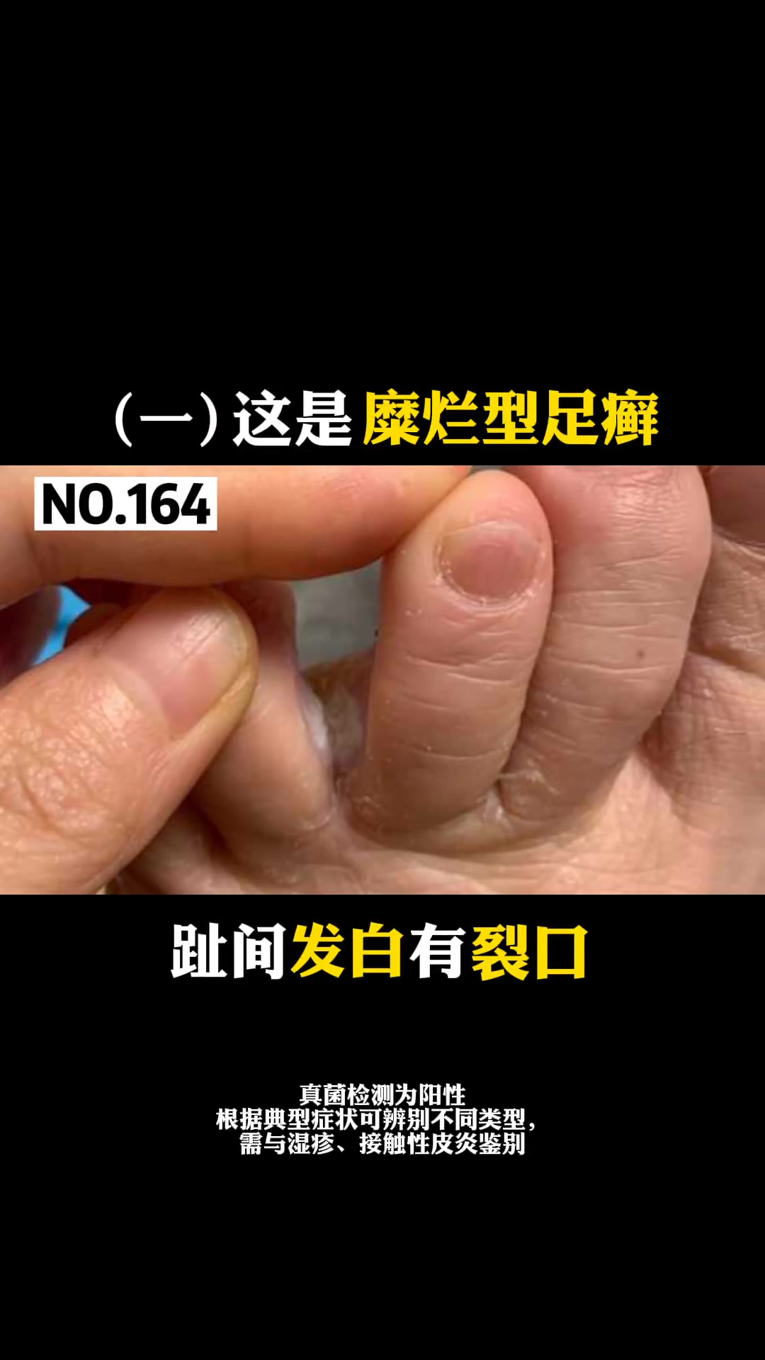 脚上上小水疱,脚趾缝糜烂,脚后跟增厚开裂,都是脚气的症状,同时出现,不同情况也需要不同处理