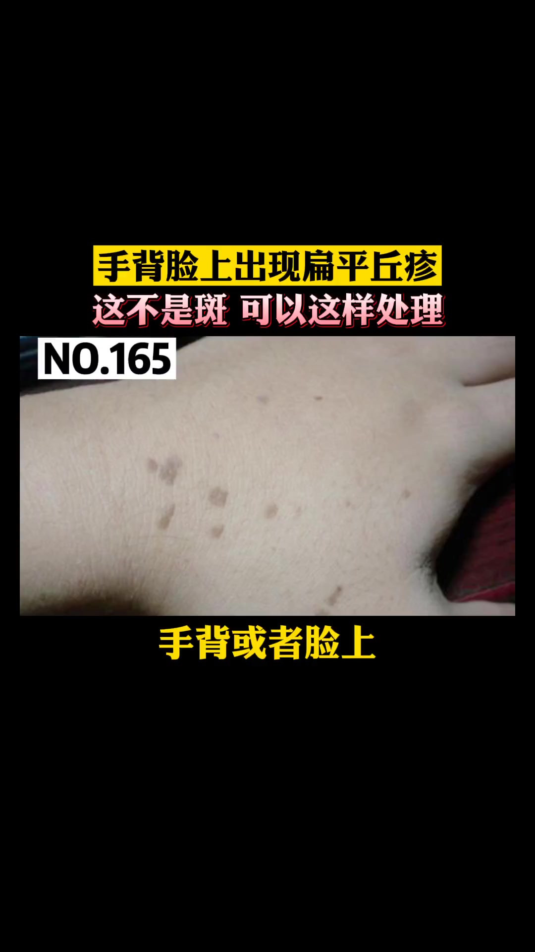 手背,脸上出现这样的扁平丘疹,其实不是斑,这是 扁平疣,可以这样处理 科普 国庆